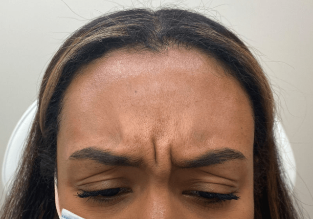 Botox before at ZONA MED SPA in Scottsdale, AZ