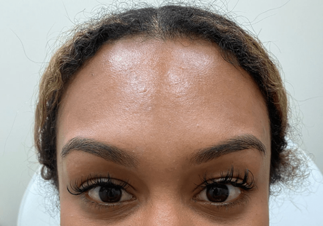 Botox after at ZONA MED SPA in Scottsdale, AZ