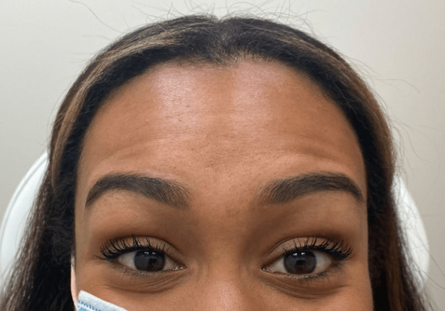 Botox before at ZONA MED SPA in Scottsdale, AZ