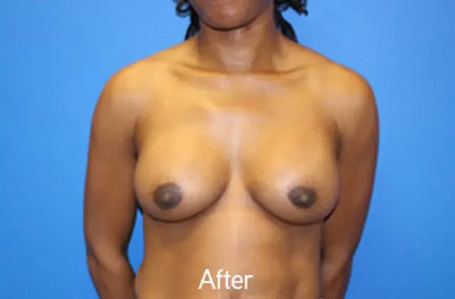 Breast Augmentation after at Criswell & Criswell Plastic Surgery & MedSpa in Charlotte, NC