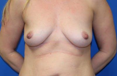 Breast Augmentation before at Criswell & Criswell Plastic Surgery & MedSpa in Charlotte, NC