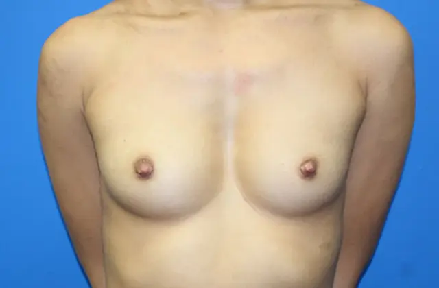 Breast Augmentation before at Criswell & Criswell Plastic Surgery & MedSpa in Charlotte, NC
