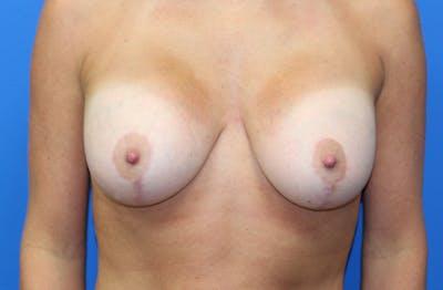 Criswell & Criswell Plastic Surgery & MedSpa breast augmentation after — Charlotte, NC
