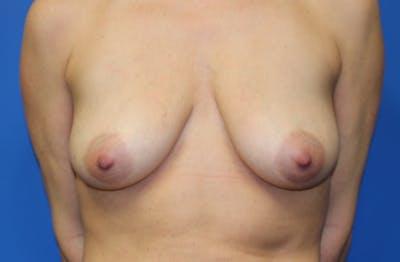 Breast Augmentation before at Criswell & Criswell Plastic Surgery & MedSpa in Charlotte, NC