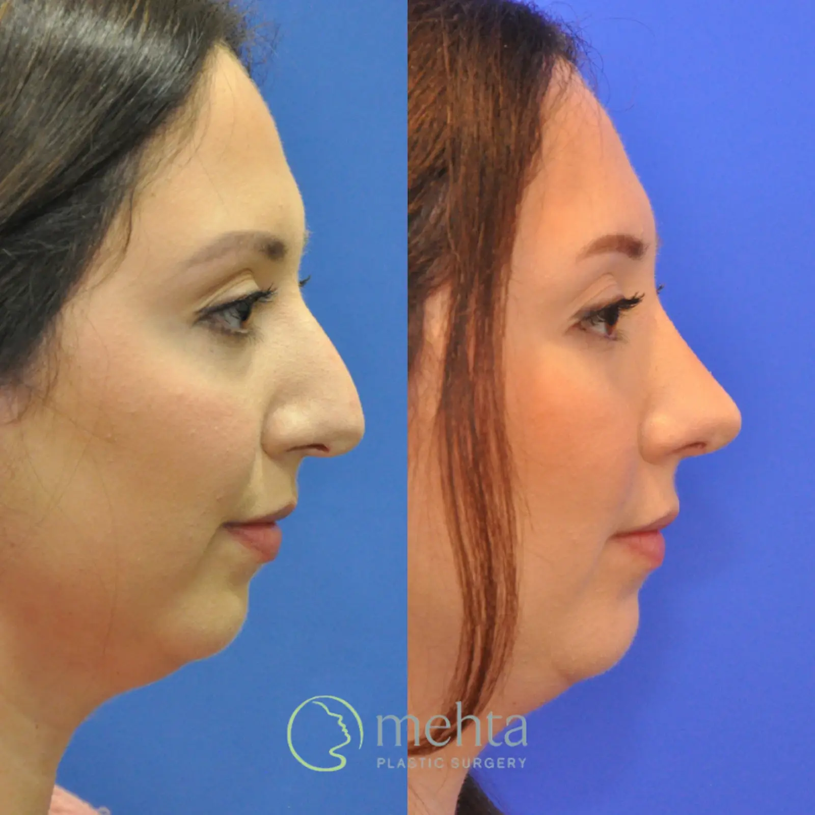 Mehta Plastic Surgery rhinoplasty result — Menlo Park, CA