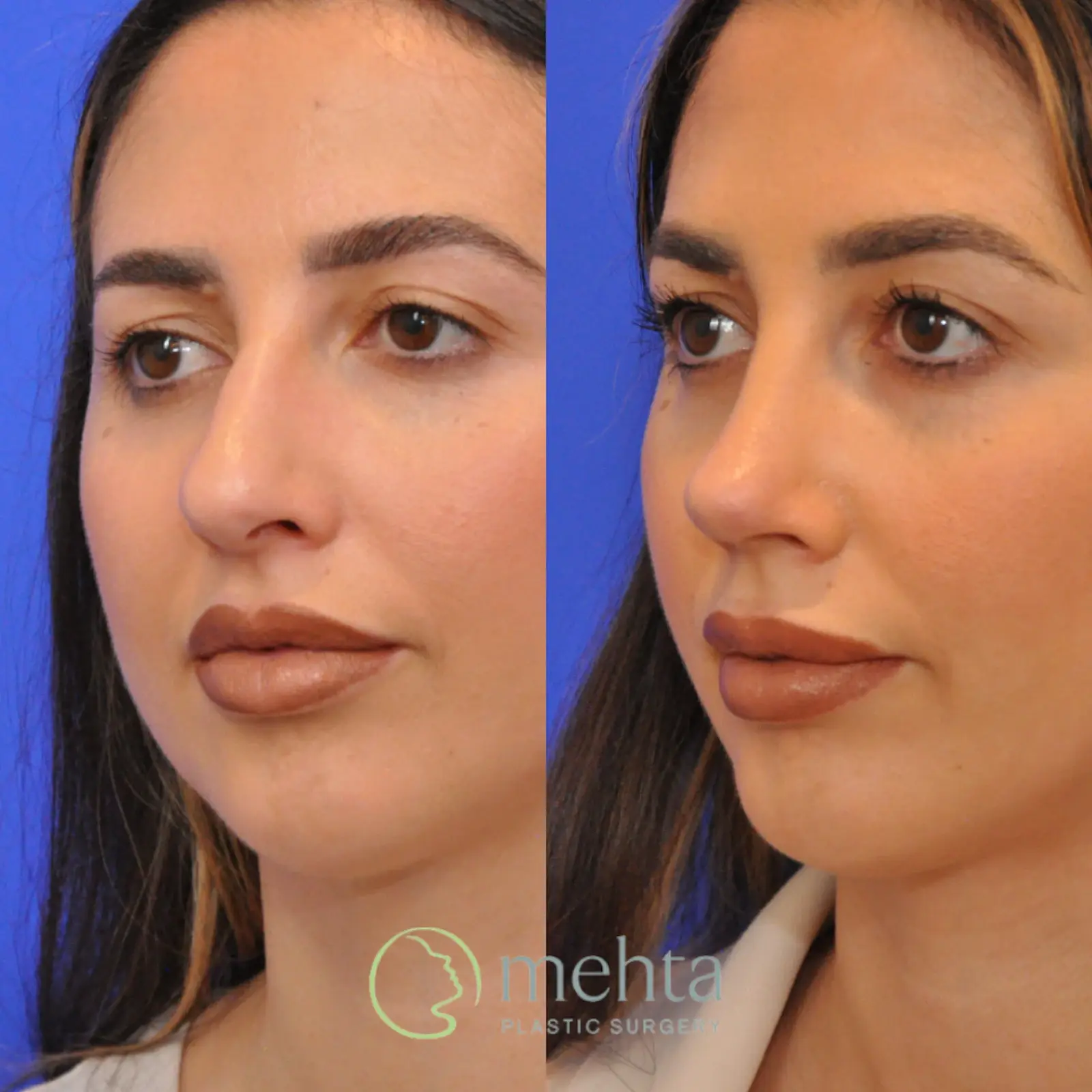 Mehta Plastic Surgery rhinoplasty result — Menlo Park, CA