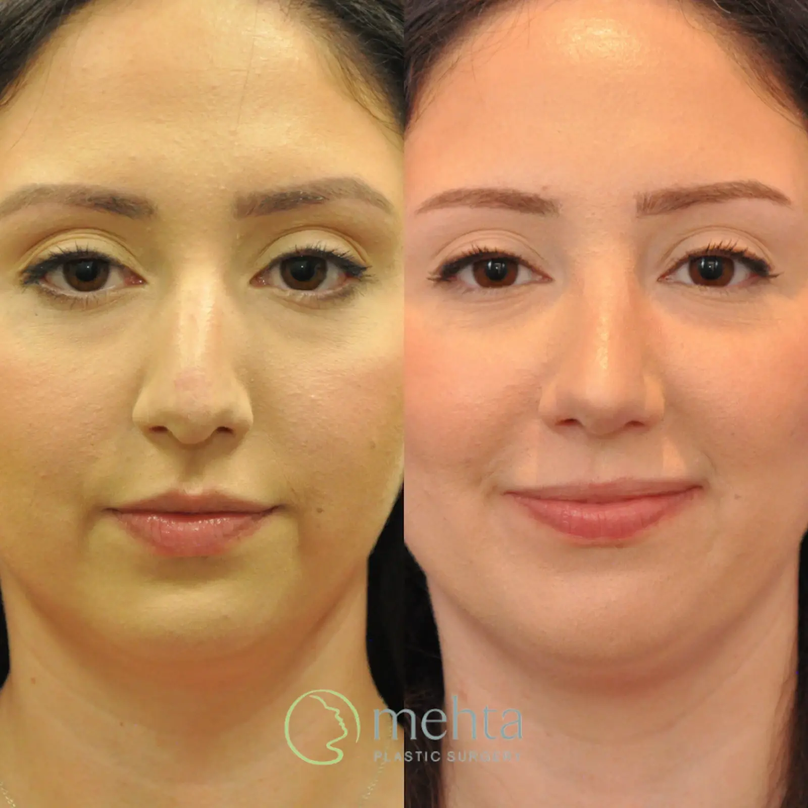 Mehta Plastic Surgery rhinoplasty result — Menlo Park, CA