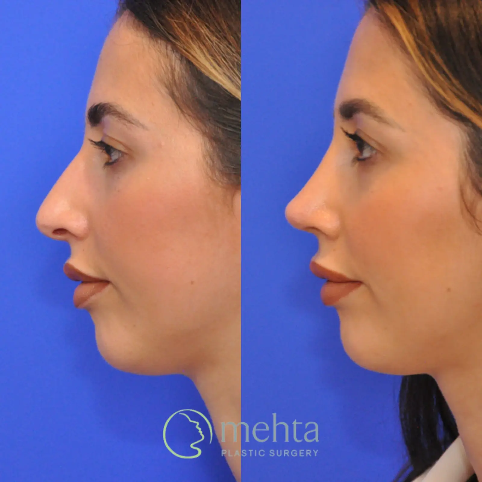 Mehta Plastic Surgery rhinoplasty result — Menlo Park, CA