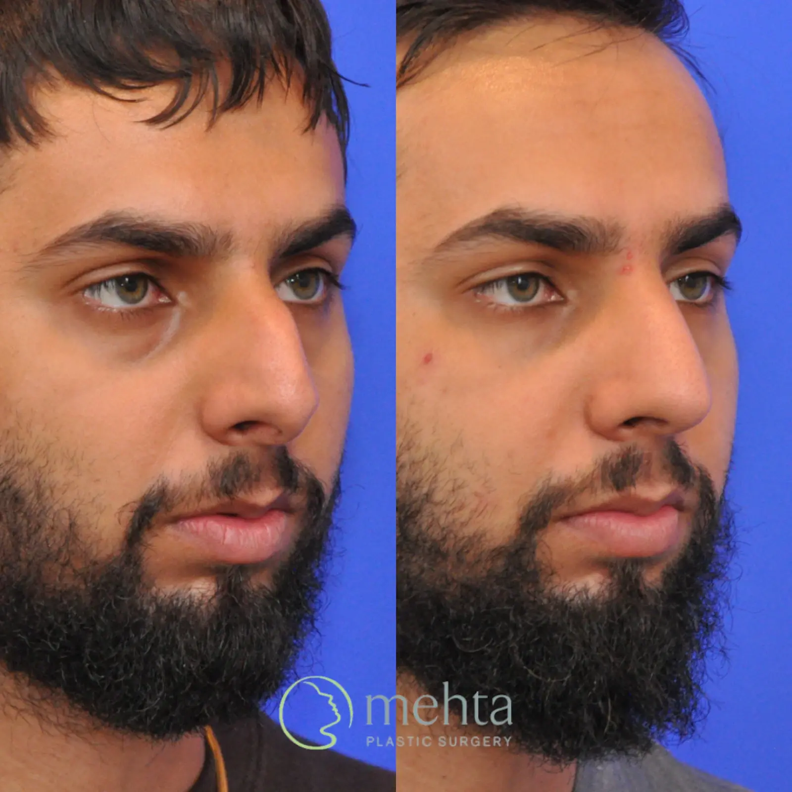 Mehta Plastic Surgery rhinoplasty result — Menlo Park, CA