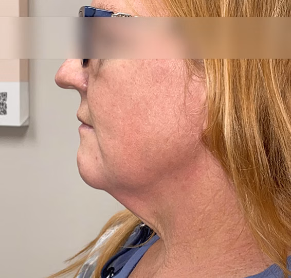 Deep Plane Facelift after at ElaMar Nashville in Nashville, TN