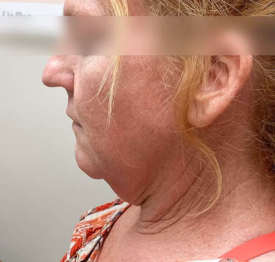 Deep Plane Facelift before at ElaMar Nashville in Nashville, TN