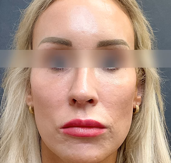 Juvederm after at ElaMar Nashville in Nashville, TN