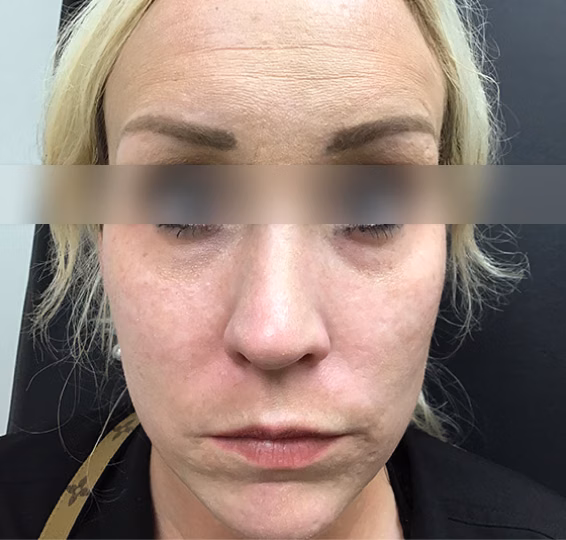 Juvederm before at ElaMar Nashville in Nashville, TN