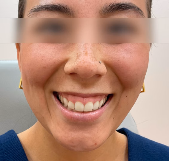 Dental Veneers before at ElaMar Nashville in Nashville, TN