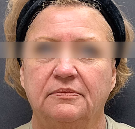 Deep Plane Facelift before at ElaMar Nashville in Nashville, TN