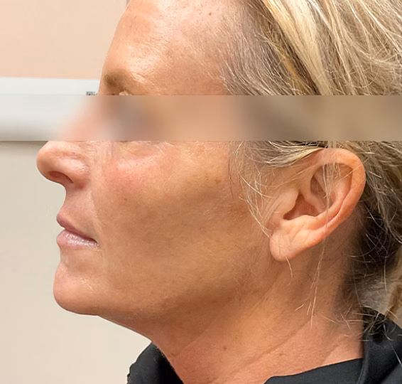 Deep Plane Facelift before at ElaMar Nashville in Nashville, TN