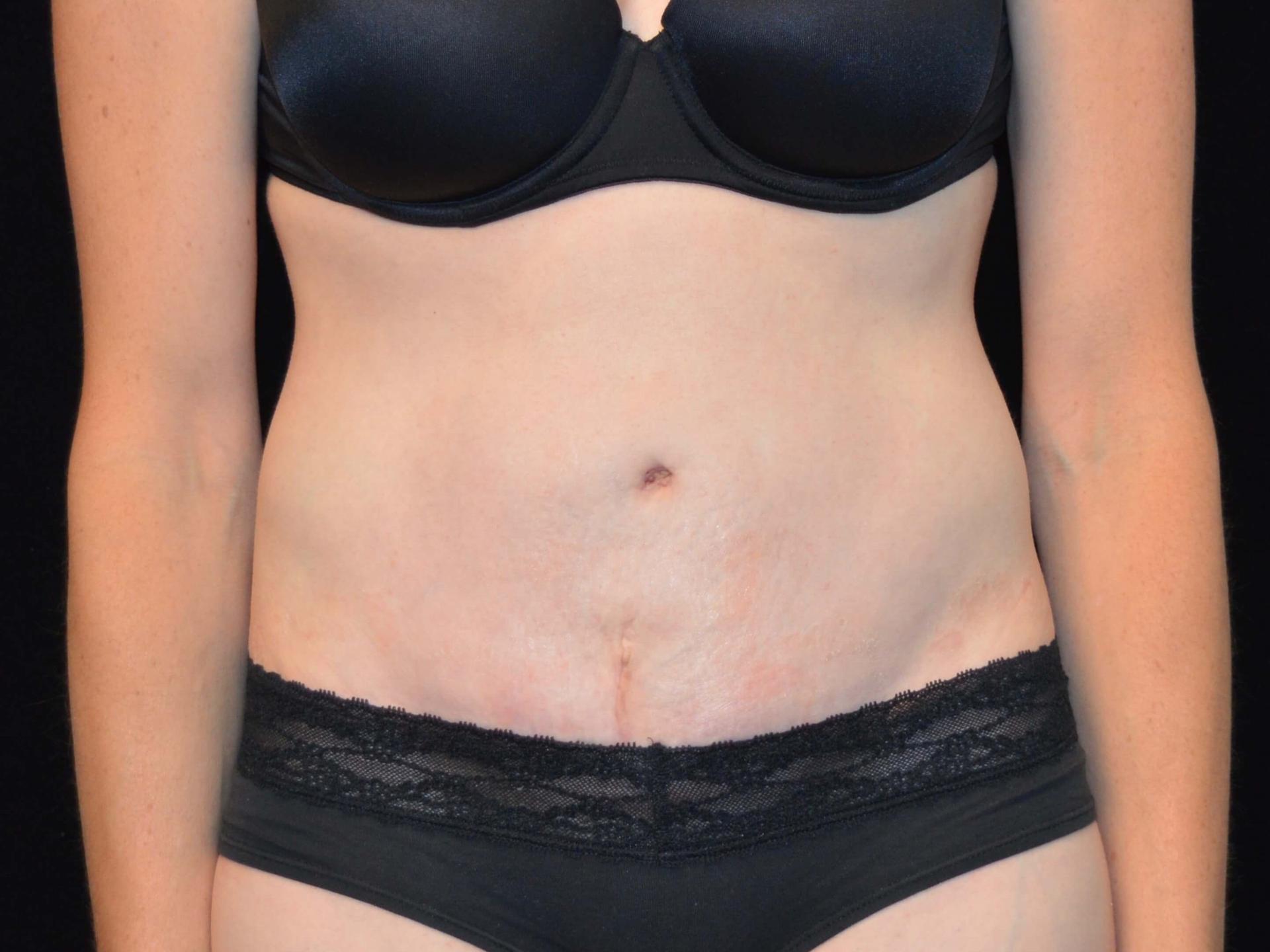 SAC Plastic Surgery tummy tuck after — Oak Lawn, IL