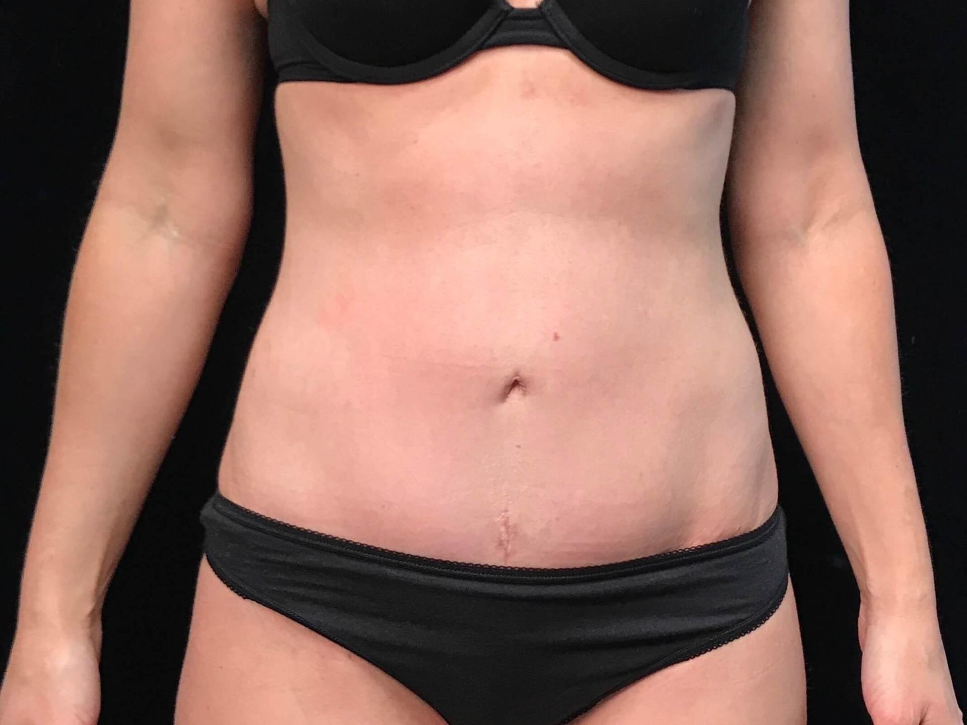 SAC Plastic Surgery tummy tuck after — Oak Lawn, IL