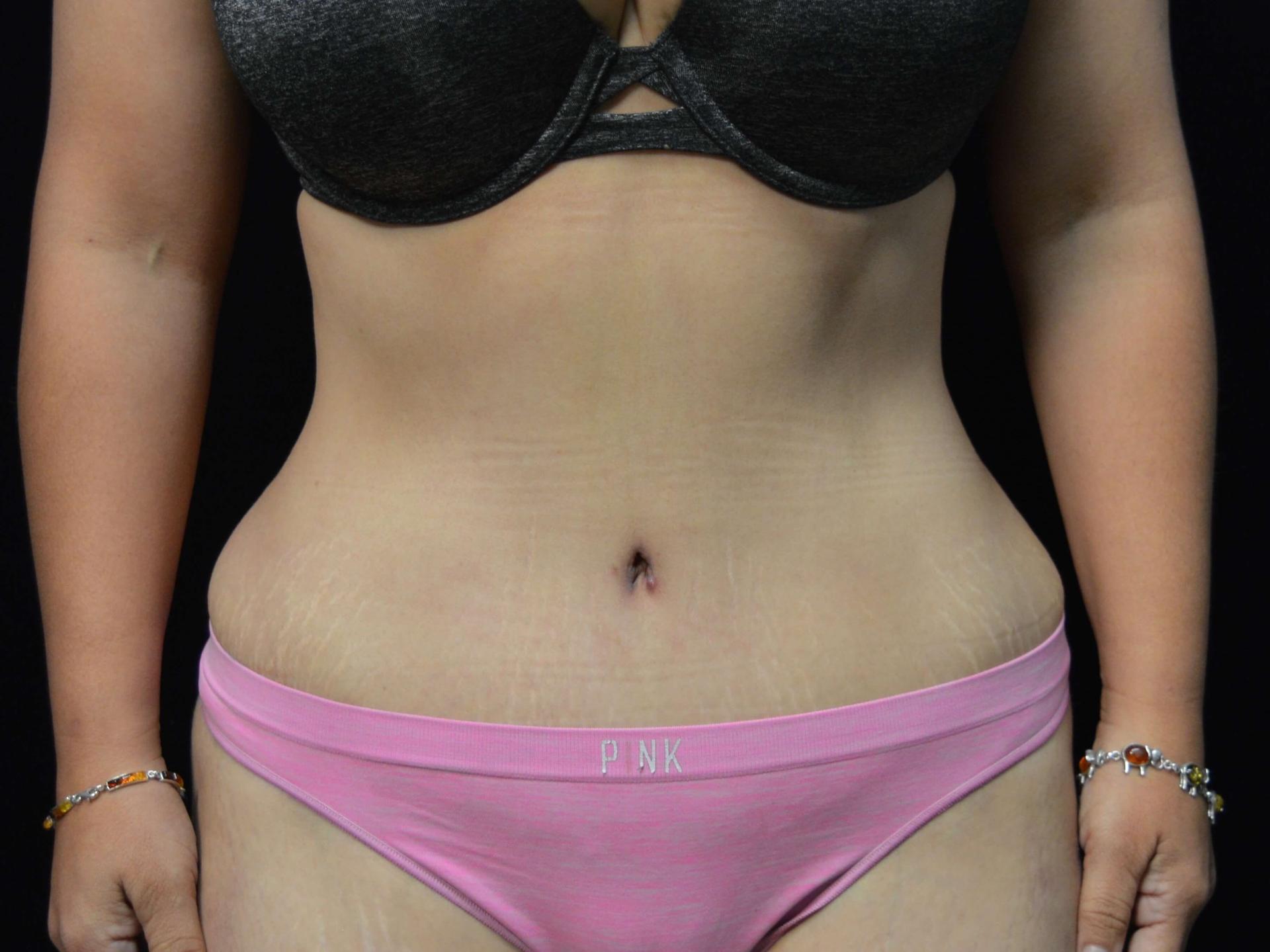 SAC Plastic Surgery tummy tuck after — Oak Lawn, IL