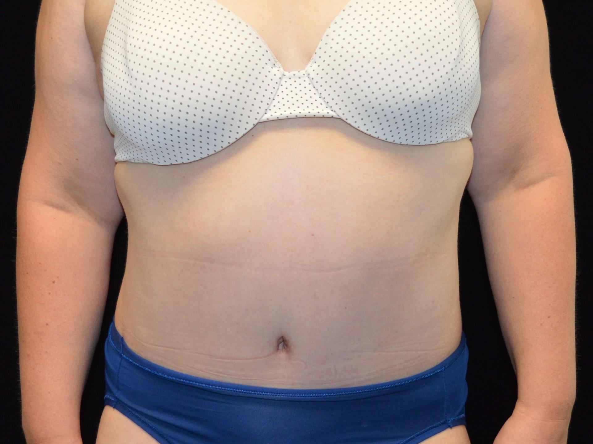 SAC Plastic Surgery tummy tuck after — Oak Lawn, IL