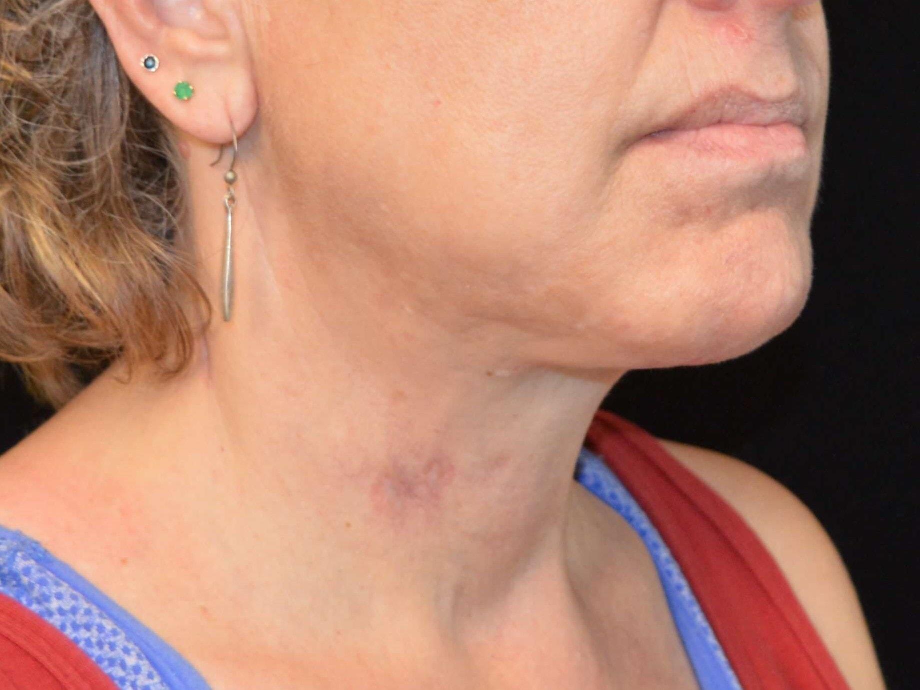SAC Plastic Surgery neck lift after — Oak Lawn, IL