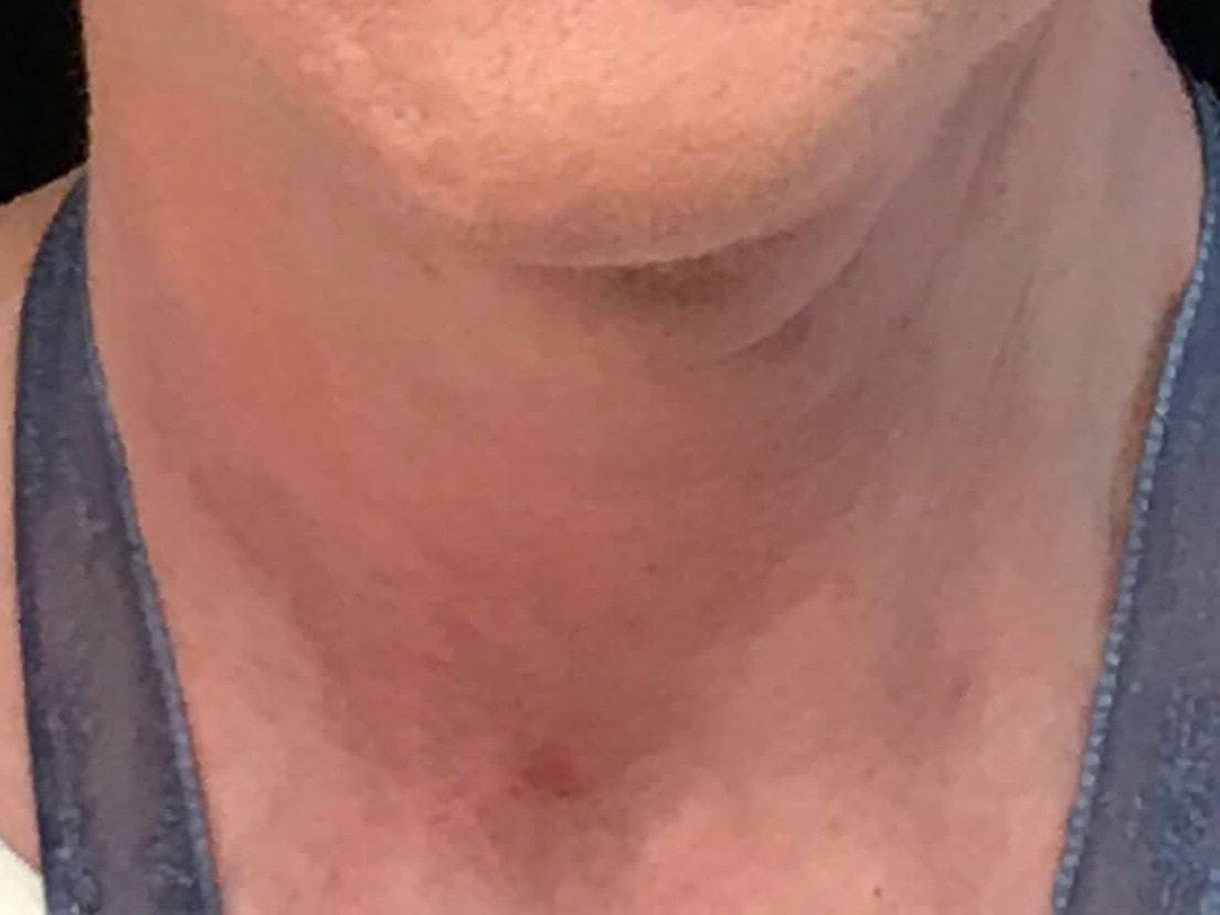 SAC Plastic Surgery neck lift after — Oak Lawn, IL