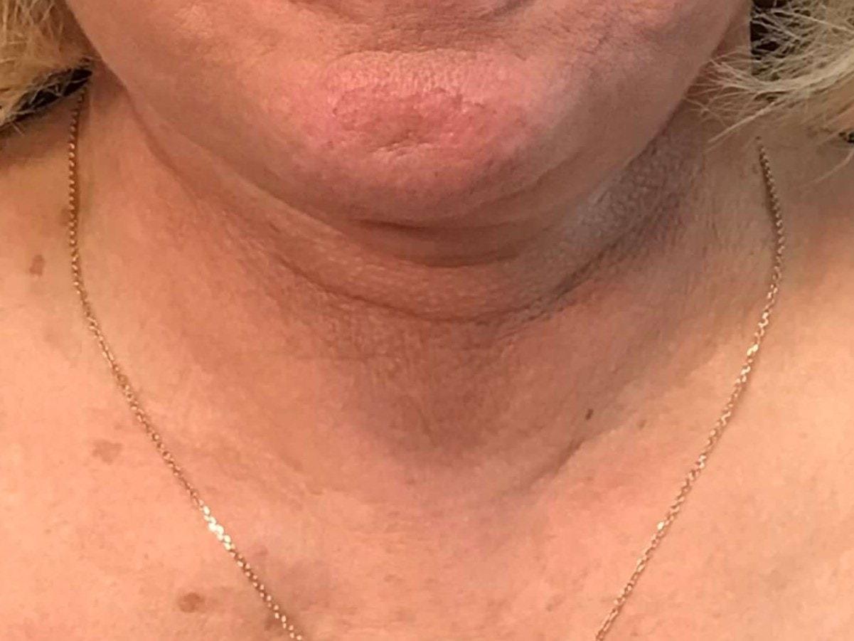 SAC Plastic Surgery neck lift after — Oak Lawn, IL