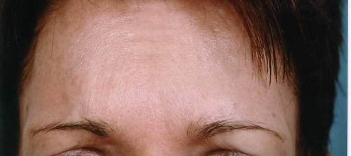 Lee Facial Plastic Surgery botox after — Weston, MA