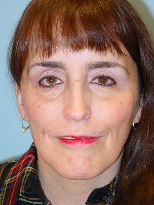 Lee Facial Plastic Surgery facelift after — Weston, MA