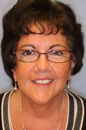 Lee Facial Plastic Surgery facelift after — Weston, MA