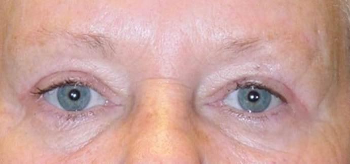 Lee Facial Plastic Surgery eyelid lift after — Weston, MA
