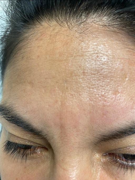 Edwin H. Moreano, MD (Surgery and Art) botox after — Queens, NY