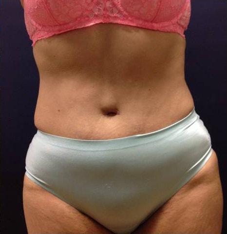 Edwin H. Moreano, MD (Surgery and Art) tummy tuck after — Queens, NY
