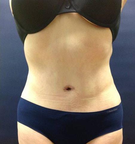 Edwin H. Moreano, MD (Surgery and Art) tummy tuck after — Queens, NY