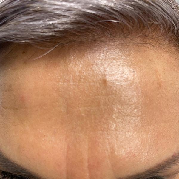 Edwin H. Moreano, MD (Surgery and Art) botox after — Queens, NY
