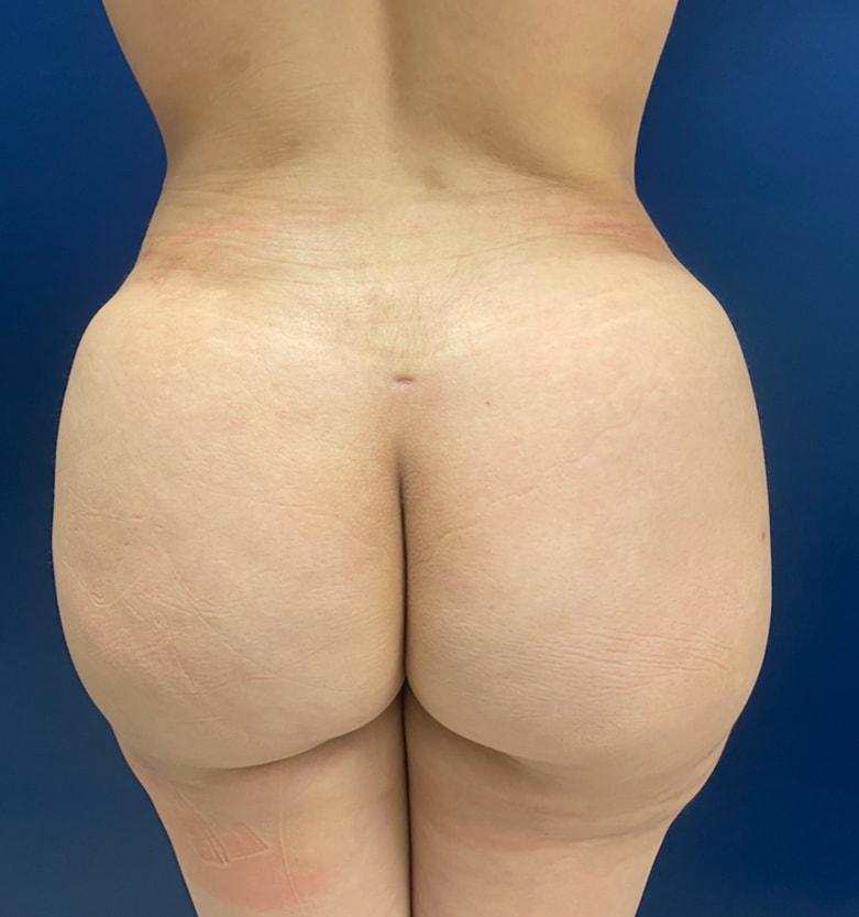 Edwin H. Moreano, MD (Surgery and Art) bbl after — Queens, NY