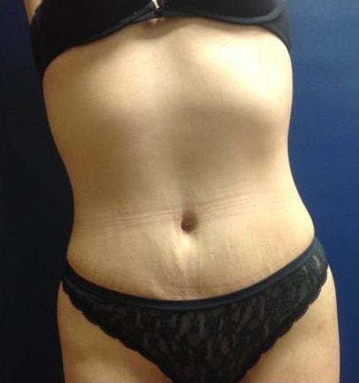 Edwin H. Moreano, MD (Surgery and Art) tummy tuck after — Queens, NY