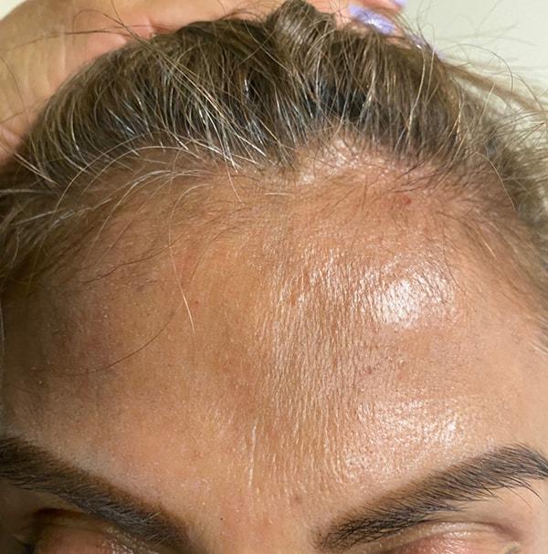 Edwin H. Moreano, MD (Surgery and Art) botox after — Queens, NY