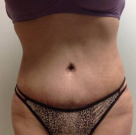 Edwin H. Moreano, MD (Surgery and Art) tummy tuck after — Queens, NY