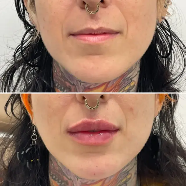 Lip Filler result at Dr. Adam J. Oppenheimer, MD in Orlando, FL
