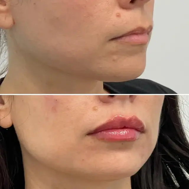 Lip Filler result at Dr. Adam J. Oppenheimer, MD in Orlando, FL