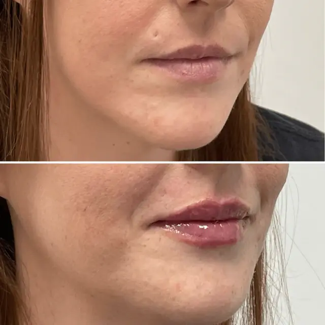 Lip Filler result at Dr. Adam J. Oppenheimer, MD in Orlando, FL