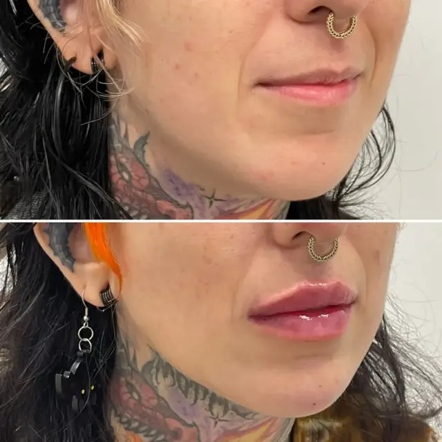 Lip Filler result at Dr. Adam J. Oppenheimer, MD in Orlando, FL
