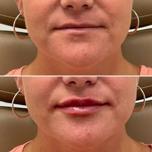 Lip Filler result at Dr. Adam J. Oppenheimer, MD in Orlando, FL