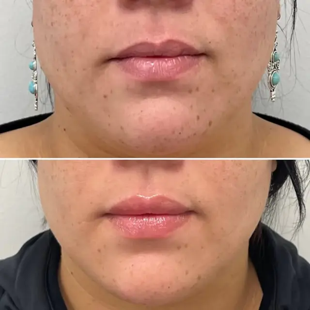 Lip Filler result at Dr. Adam J. Oppenheimer, MD in Orlando, FL
