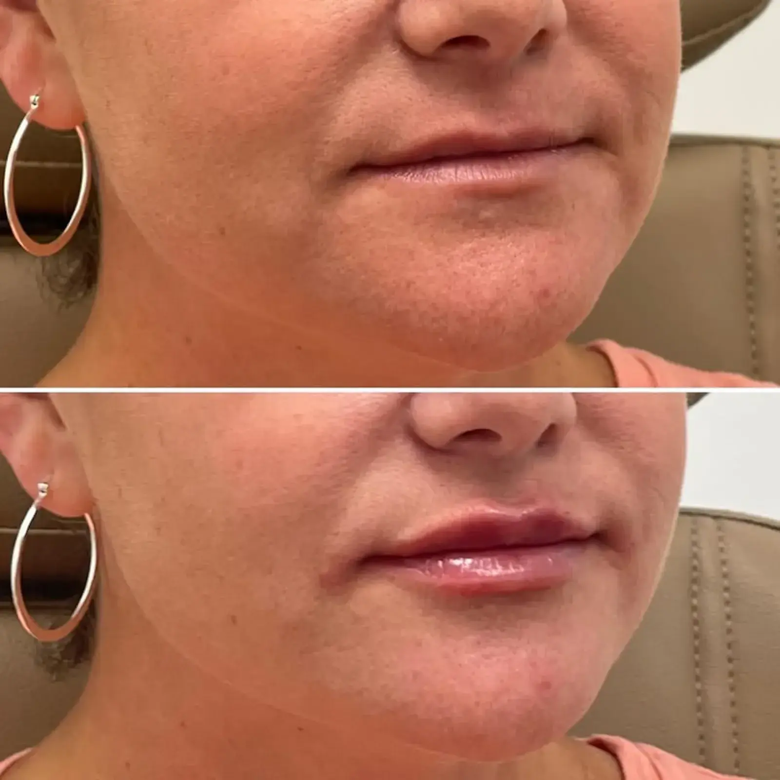 Dr. Adam J. Oppenheimer, MD lip filler result — Orlando, FL