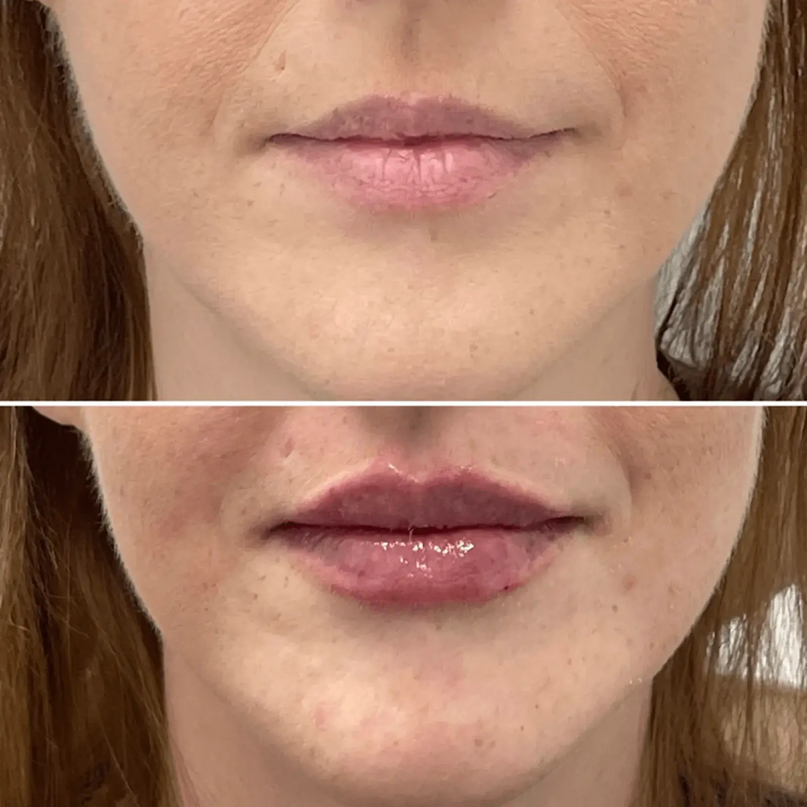 Dr. Adam J. Oppenheimer, MD lip filler result — Orlando, FL