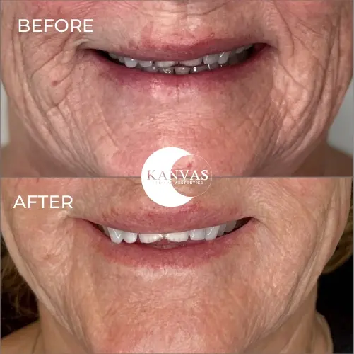 Kanvas Medical Aesthetics result — Indianapolis, IN