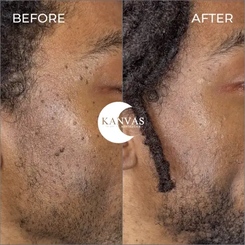 Kanvas Medical Aesthetics result — Indianapolis, IN