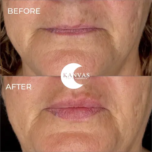Lip Filler result at Kanvas Medical Aesthetics in Indianapolis, IN